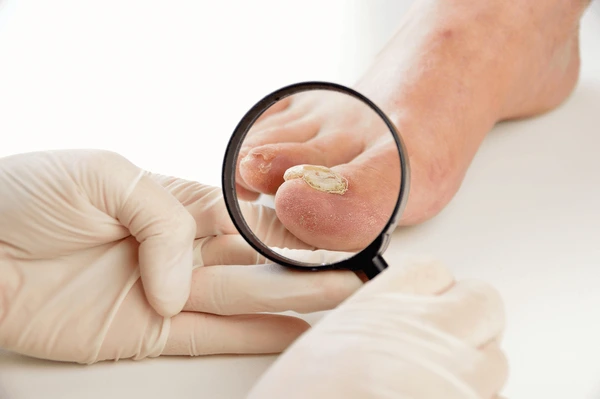 Nail Treatment in Lucknow